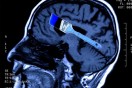Biological basis for creativity linked to mental illness